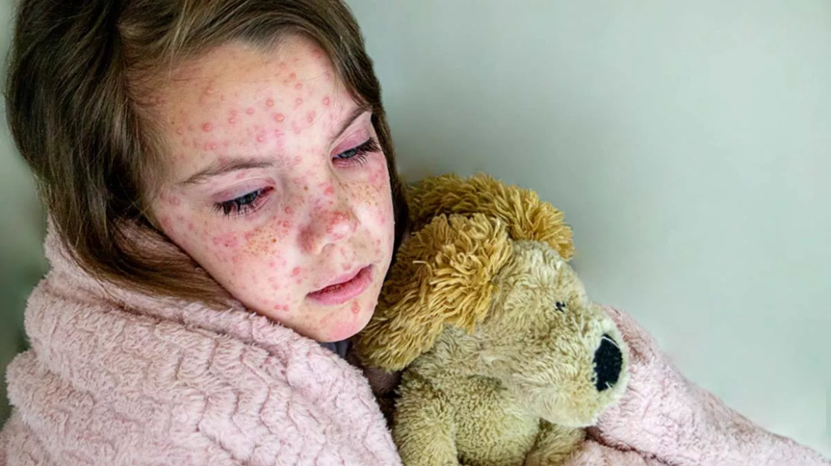 Ιλαρά: Πάνω από 10 εκατομμύρια κρούσματα το 2023 – Πόσες ζωές χάθηκαν