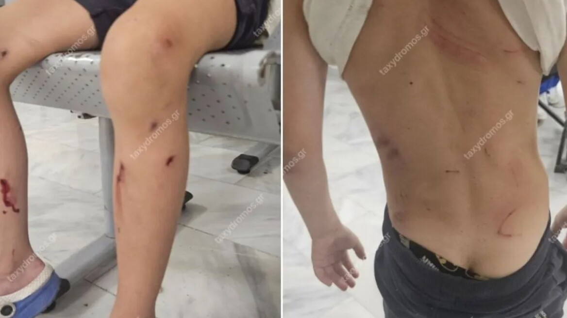 Βόλος: Από θαύμα γλίτωσε 7χρονος όταν του επιτέθηκαν αδέσποτα σκυλιά - Παραλίγο να το κατασπαράξουν, λέει η μητέρα του