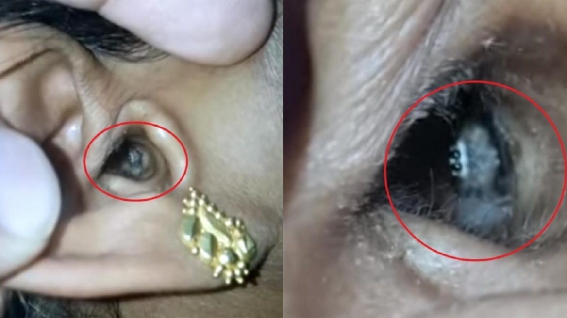 Πήγε στον γιατρό για τον πονοκέφαλο και βρήκαν αράχνη στο αυτί της (ΒΙΝΤΕΟ)