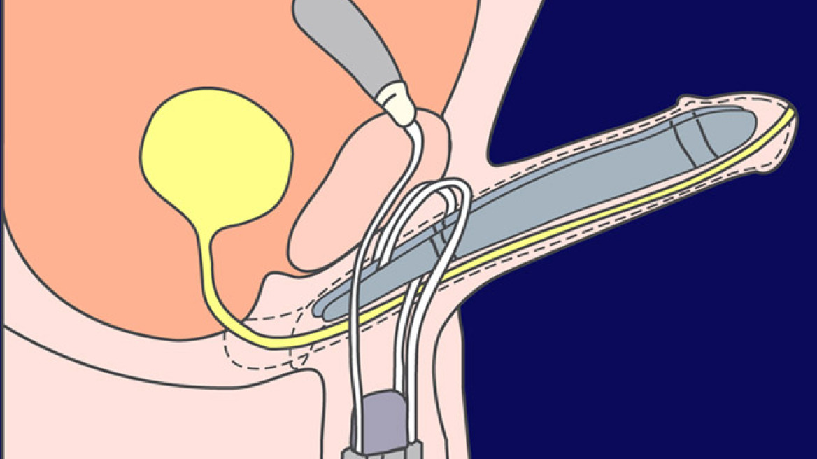 Χειρουργική αντιμετώπιση της στυτικής δυσλειτουργίας