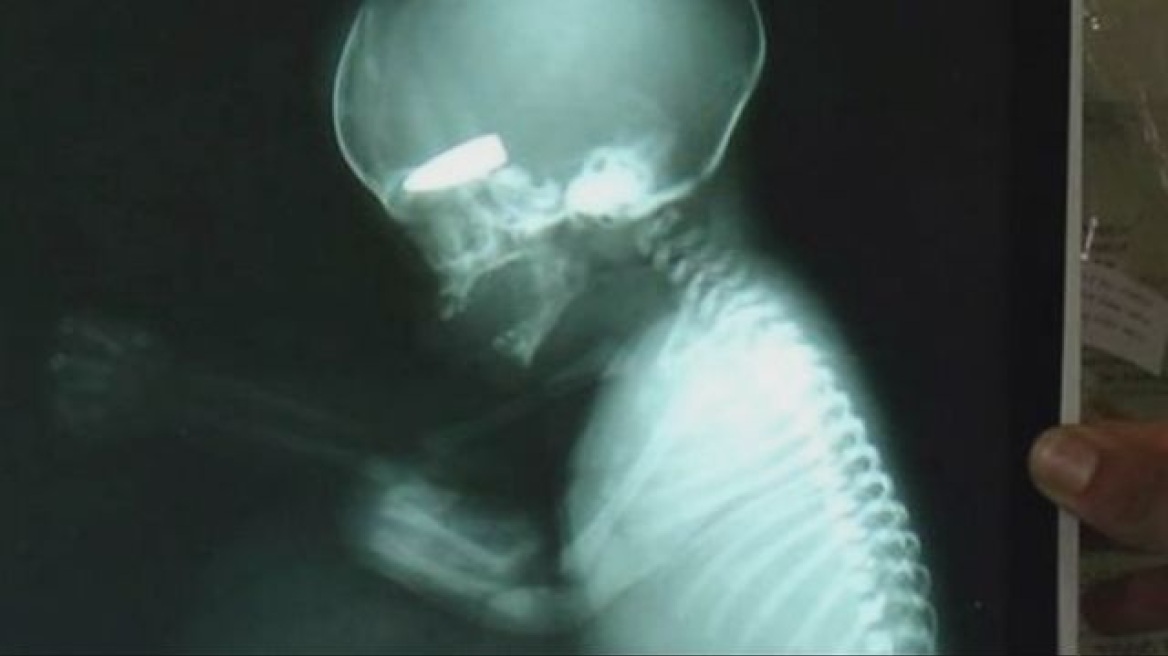 Εικόνα-σοκ: Έμβρυο με σφαίρα στο κρανίο από ελεύθερο σκοπευτή στη Συρία