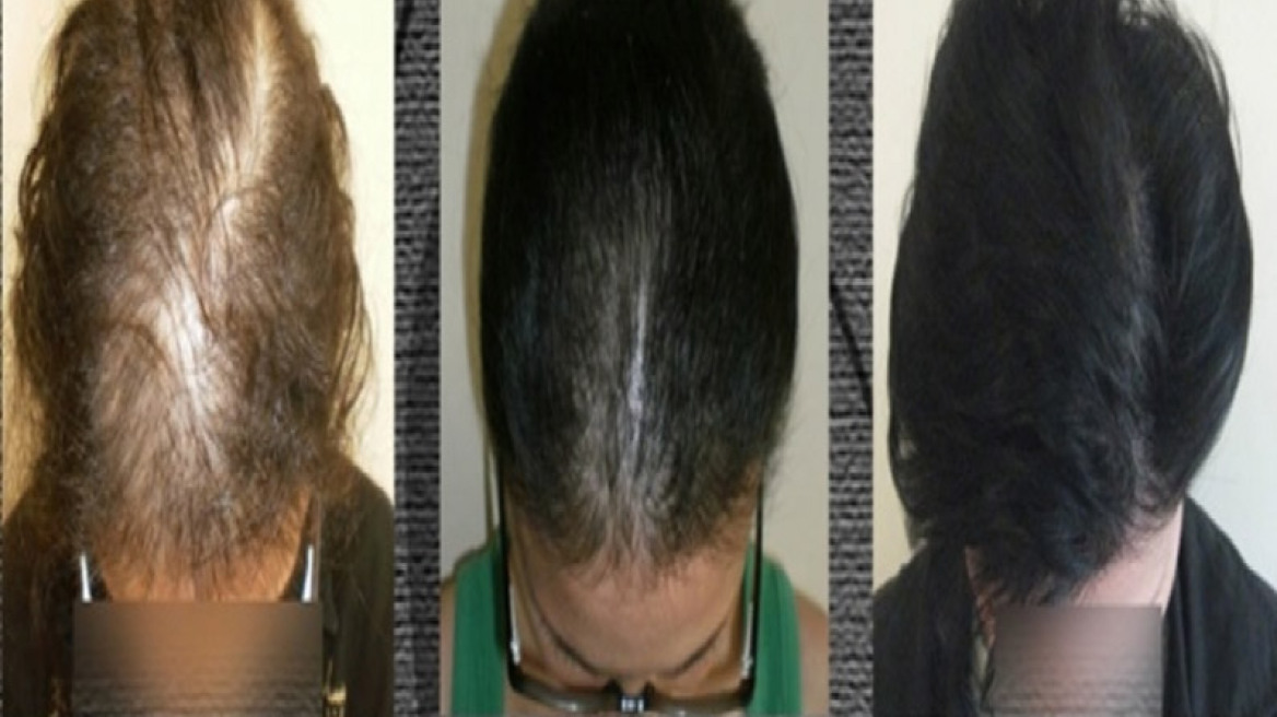 PRP:Καινοτόμος θεραπεία της τριχόπτωσης με την χρήση αιμοπεταλίων