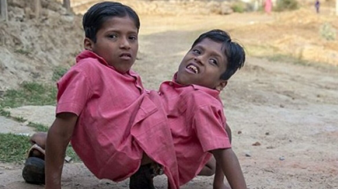 Συγκλονιστικές εικόνες από σιαμαίους στην Ινδία 