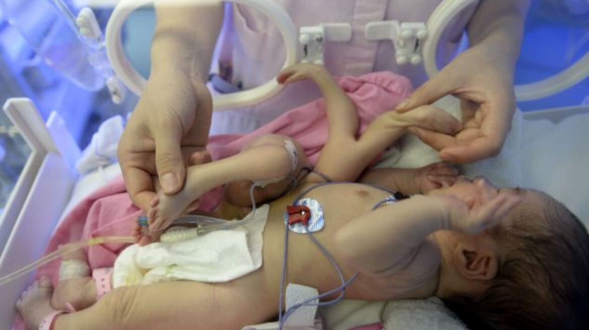 Κίνα: Μωρό γεννήθηκε με τέσσερα πόδια και τέσσερα χέρια!