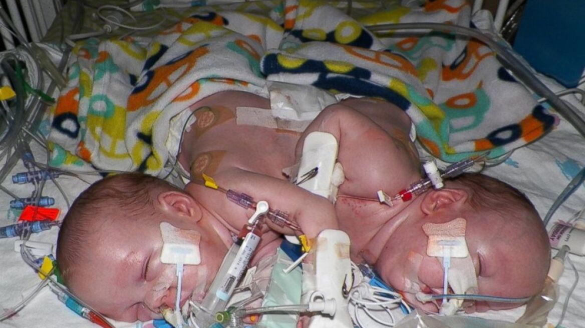 Βίντεο: Σιαμαία αγοράκια μαθαίνουν να ζουν χωριστά!