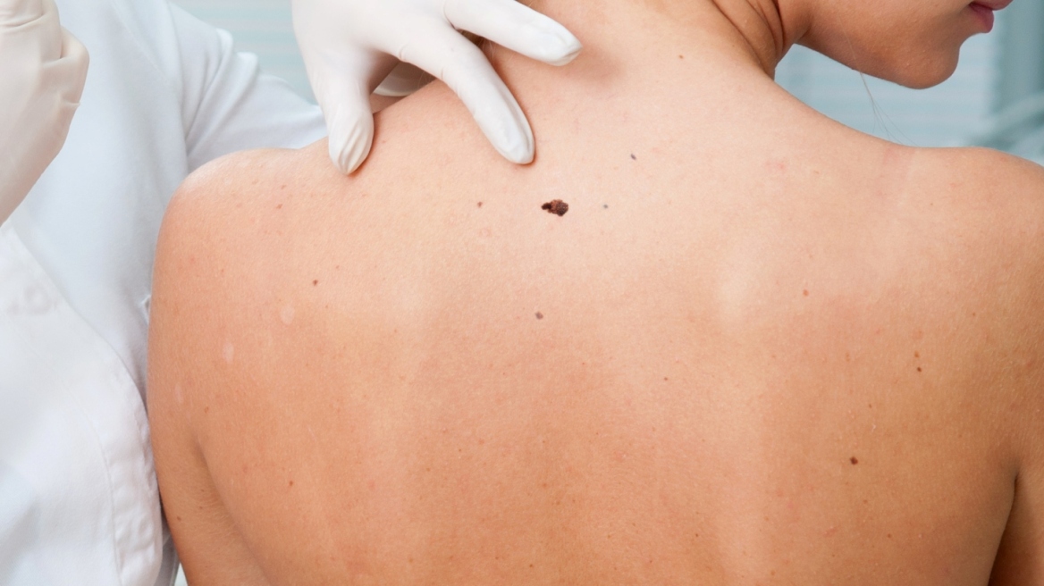 Δωρεάν δερματολογικός έλεγχος για την πρόληψη μελανωμάτων