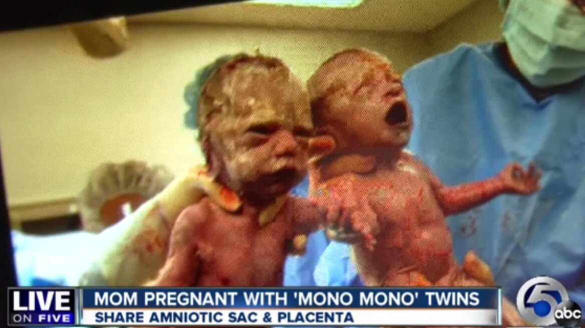 Δίδυμα γεννήθηκαν με τα χεράκια ενωμένα!