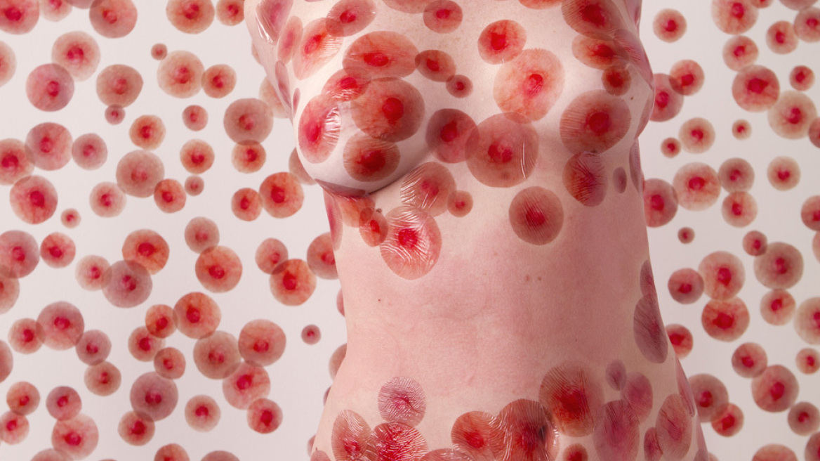 Έκανε τη δερματική πάθησή της έμπνευση και έργο τέχνης!