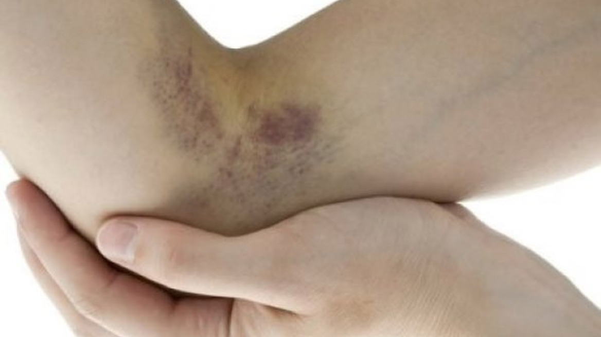 Εμφανίζεις συνεχώς μελανιές χωρίς προφανή αιτία; Αυτοί είναι οι 6 βασικοί λόγοι