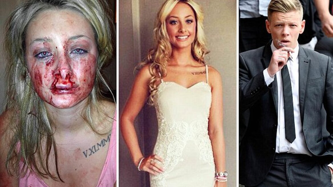 Βρετανία: Παραμόρφωσε την κοπέλα του κατά τη διάρκεια ενός φιλιού! 