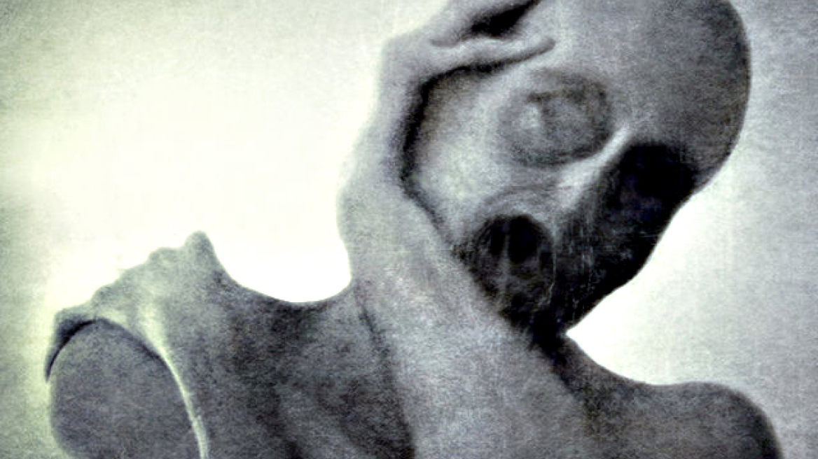 Η σχιζοφρένεια οφείλεται σε οχτώ διαφορετικές παθήσεις που δρουν παράλληλα