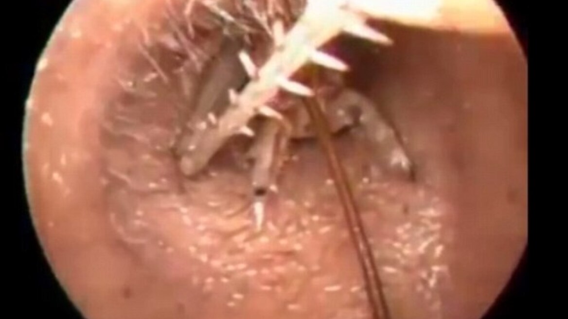 Ανατριχιαστικό βίντεο: Γρύλλος 7,5 εκατοστών στο αυτί ασθενούς!