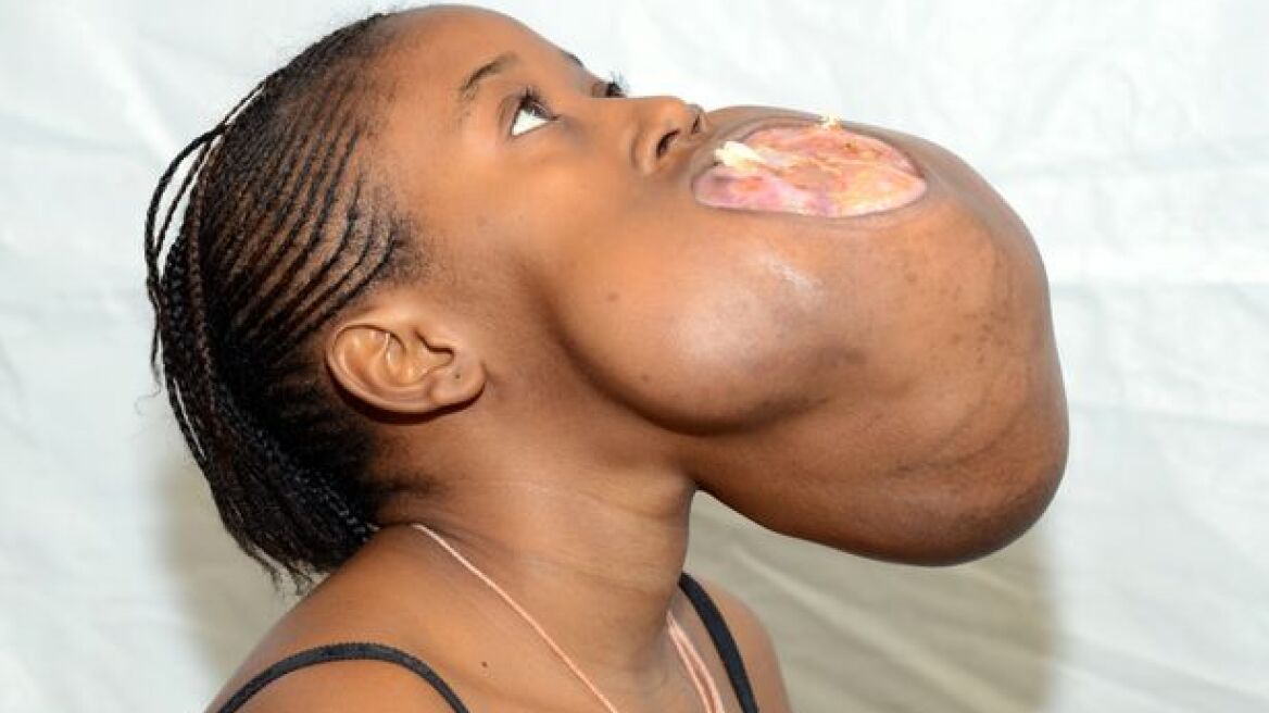 Δεκαεπτάχρονη είχε στο σαγόνι της όγκο μεγέθους μπάλας ποδοσφαίρου!