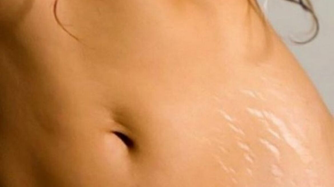 Ραγάδες και εγκυμοσύνη: Καταπολεμήστε τις φτιάχνοντας την δική σας κρέμα με φυσικά υλικά