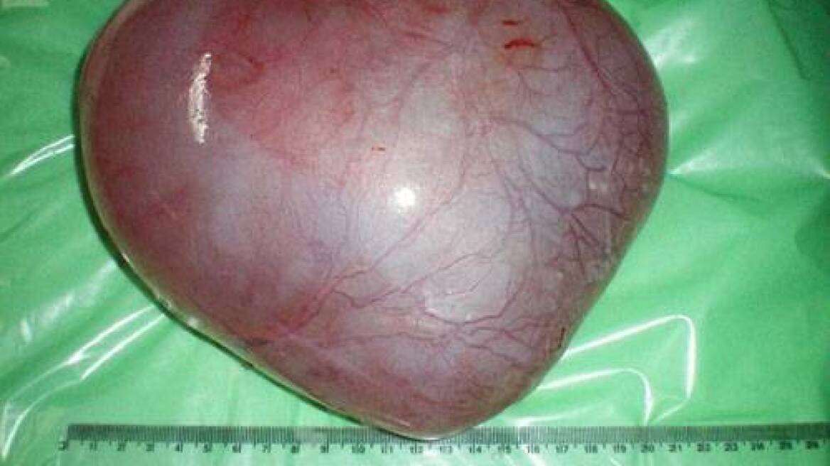 Αφαίρεσαν κύστη τεσσάρων κιλών από 5χρονο παιδί 