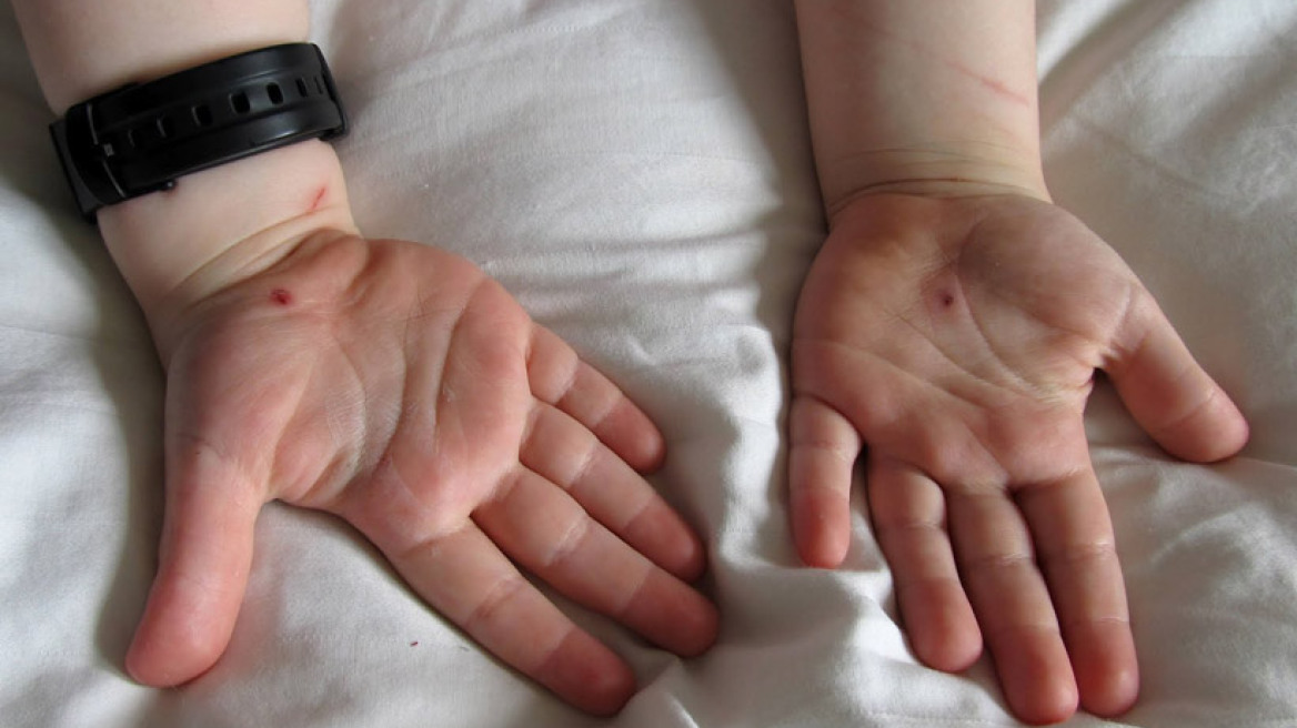 Στίγματα, τα «σημάδια του Χριστού»: Το κοριτσάκι που αιμορραγεί