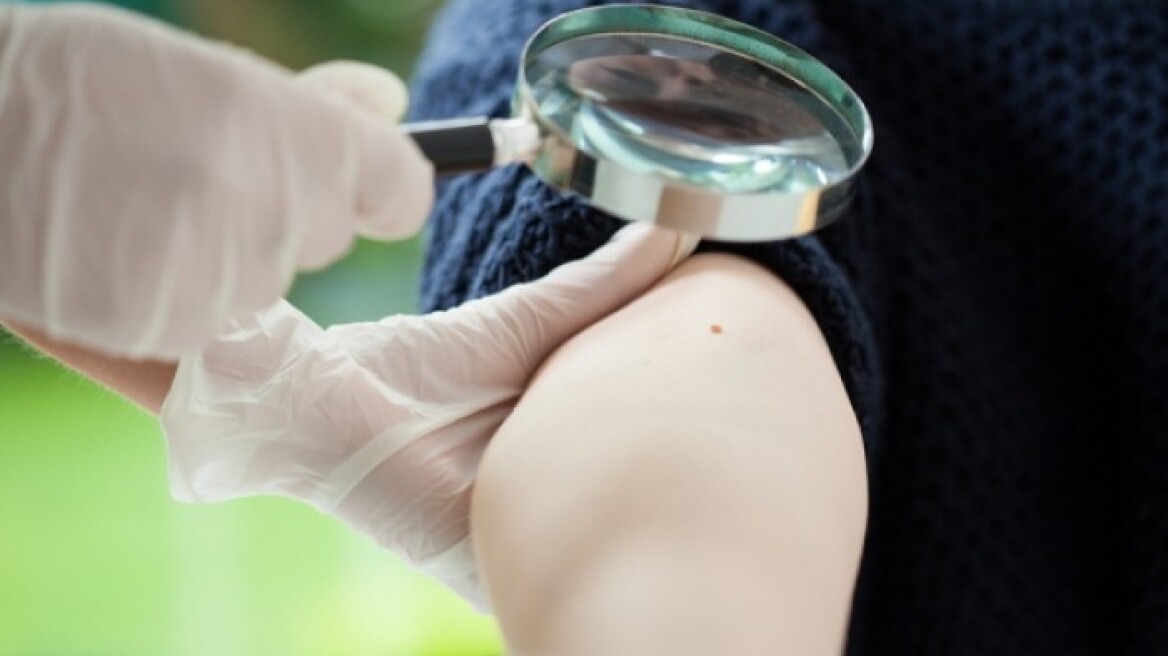 Καρκίνος του δέρματος: Δείτε ποια είναι τα συμπτώματα