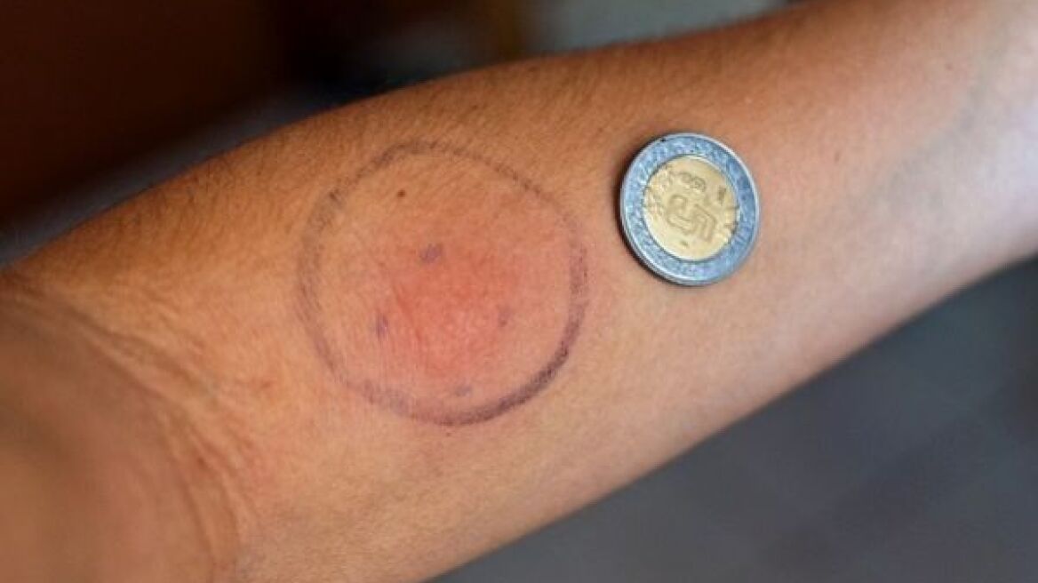 Mantoux: Τι είναι και γιατί πρέπει να γίνεται;