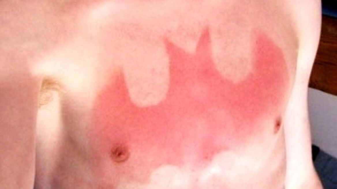 Sunburn art: Νέα επικίνδυνη μόδα βλέπει το έγκαυμα σαν... τέχνη