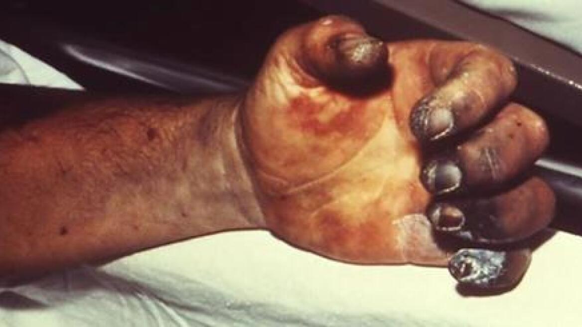 Σοκ στις ΗΠΑ: Νεκρός 70χρονος από πανώλη