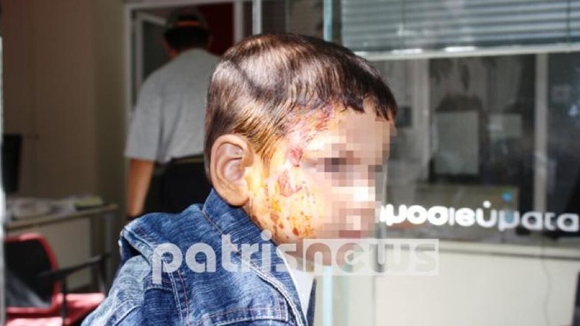 Unbelievable! Ex-employer pours coffee over toddler, causes serious burns