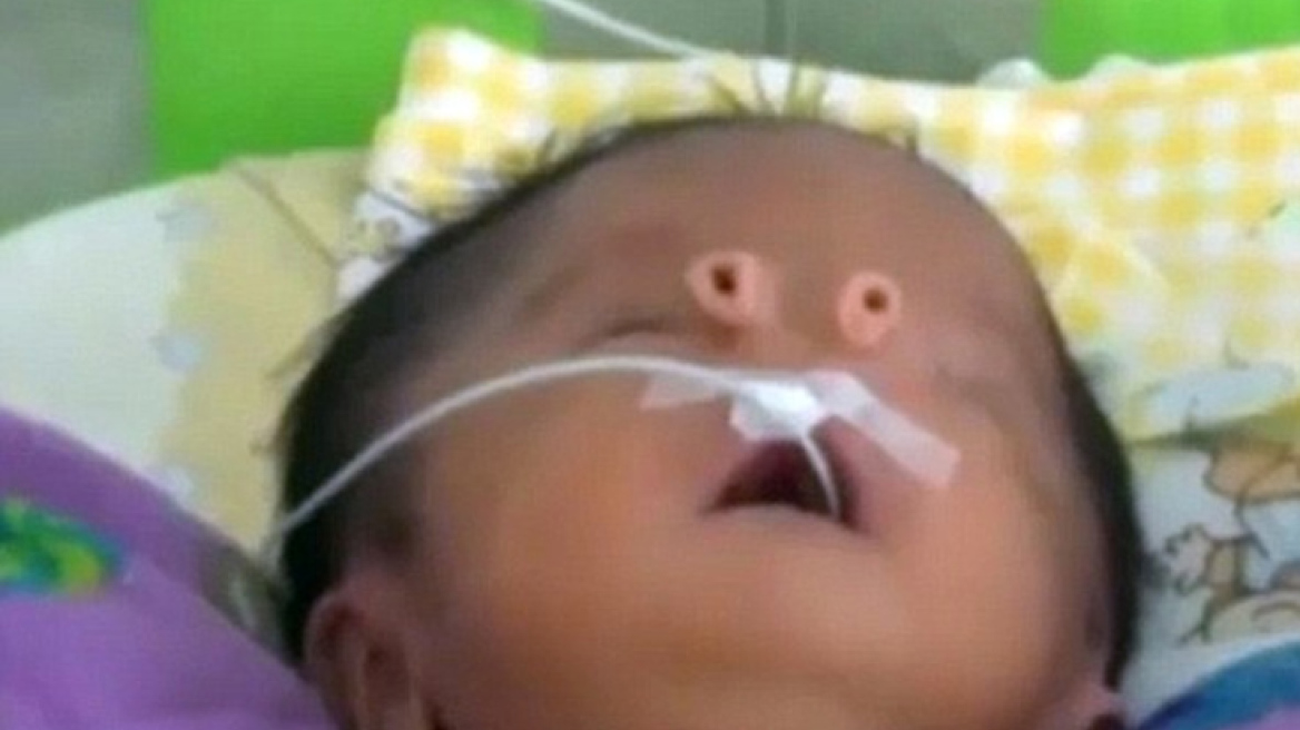 Βίντεο: Μωρό γεννήθηκε με σωληνάκια αντί για μύτη!