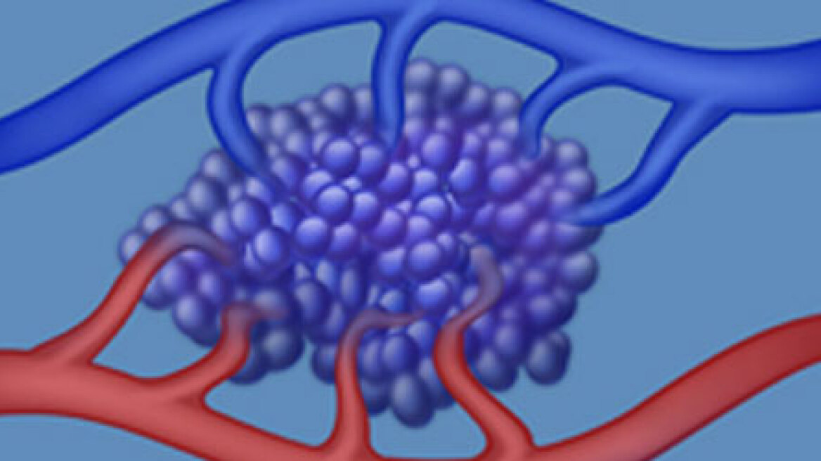 Τι είναι οι αγγειακές δυσπλασίες - Πώς αφαιρούνται