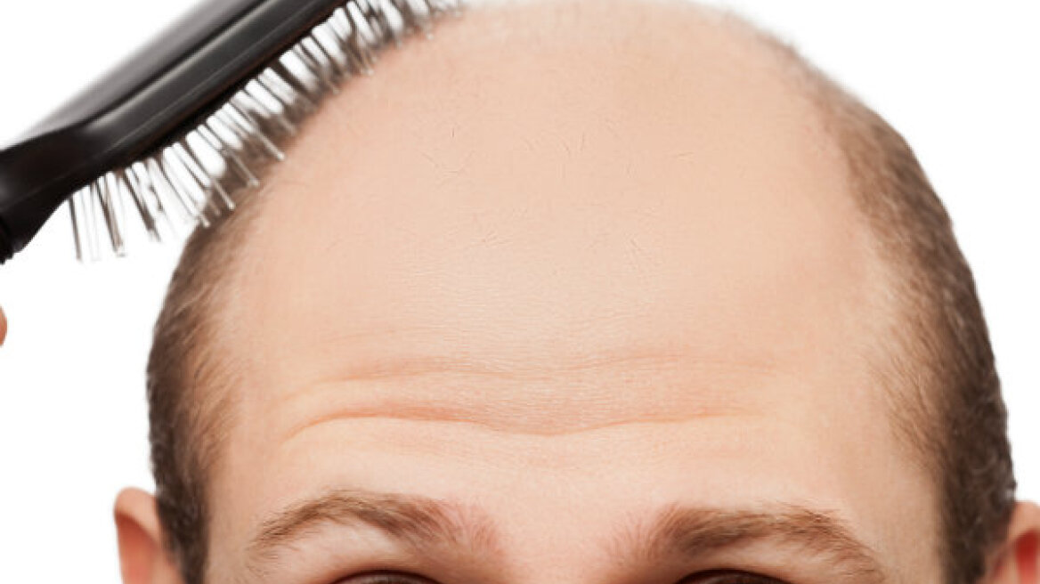 HΠA: Ανακαλύφθηκε νέα μέθοδος κατά της τριχόπτωσης