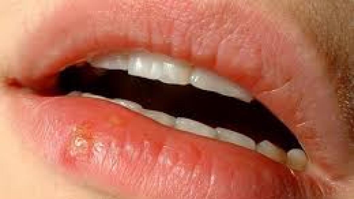Did you know that you probably have Herpes?