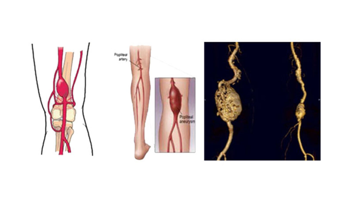 Dr. Νίκος Παρασκευάς: Ποια είναι τα συμπτώματα ενός ανευρύσματος της ιγνυακής αρτηρίας