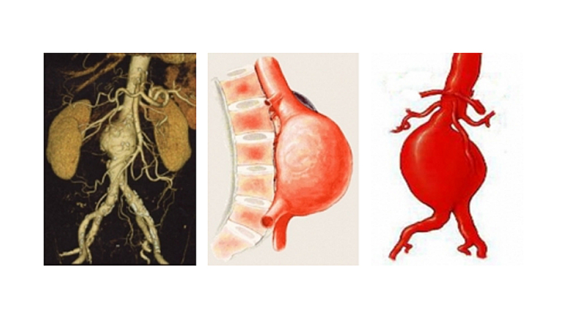H έγκαιρη διάγνωση ανευρύσματος της κοιλιακής αορτής σώζει ζωές
