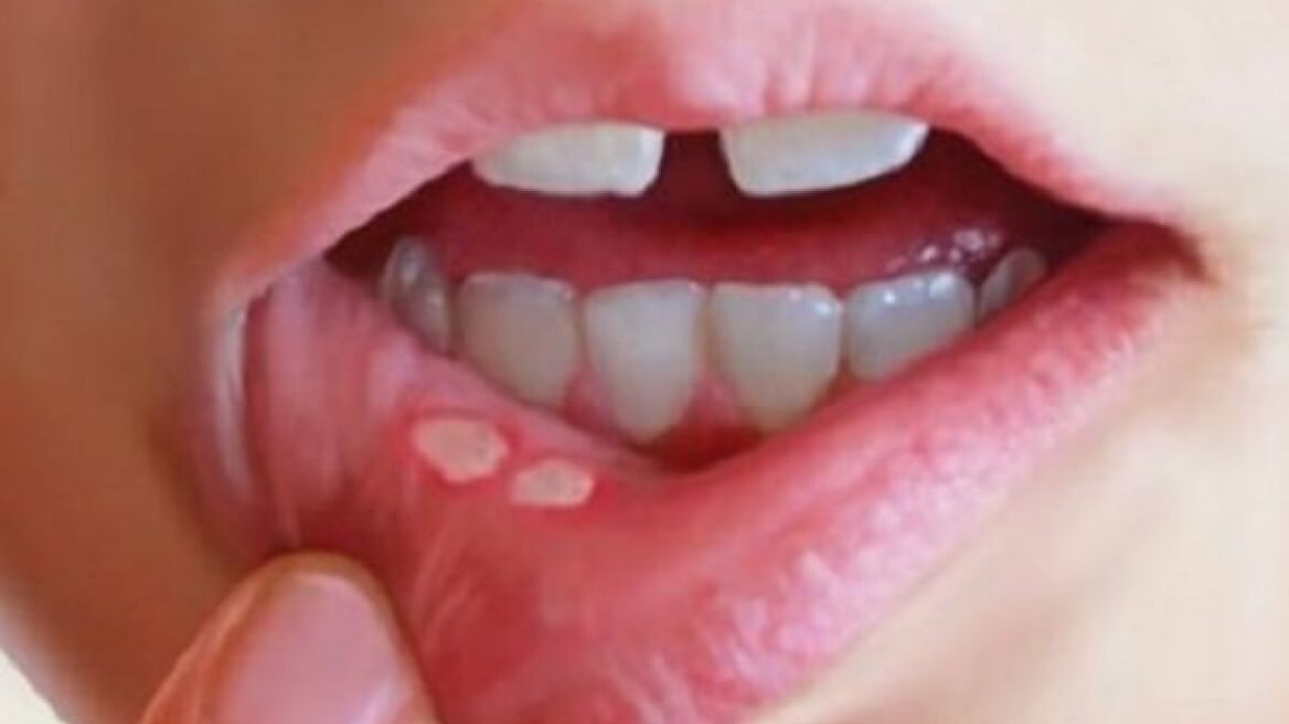 Ξέρετε τι κρύβουν οι άφθες;