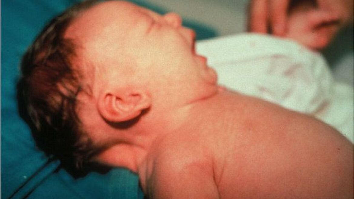 Τι είναι το σύνδρομο Turner και γιατί εμφανίζεται στα κορίτσια;