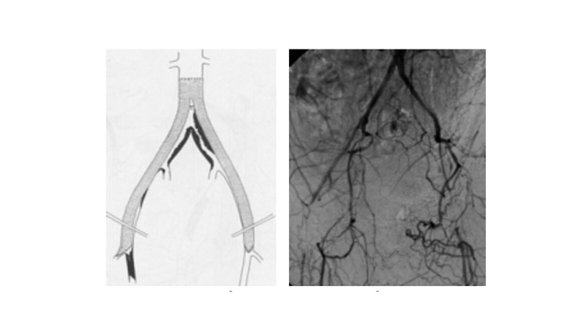 Τι είναι η αορτομηριαία παράκαμψη (bypass) και πότε πρέπει να γίνεται