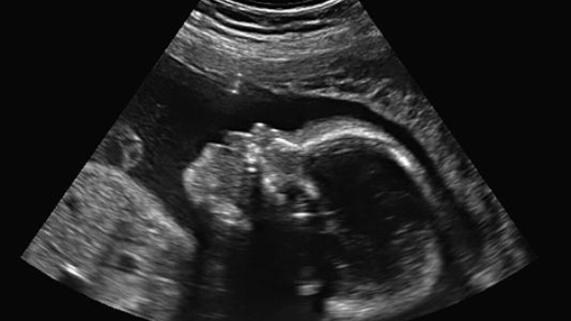 Νόμιζε πως ήταν έγκυος, αλλά είχε θανατηφόρο όγκο στην μήτρα!