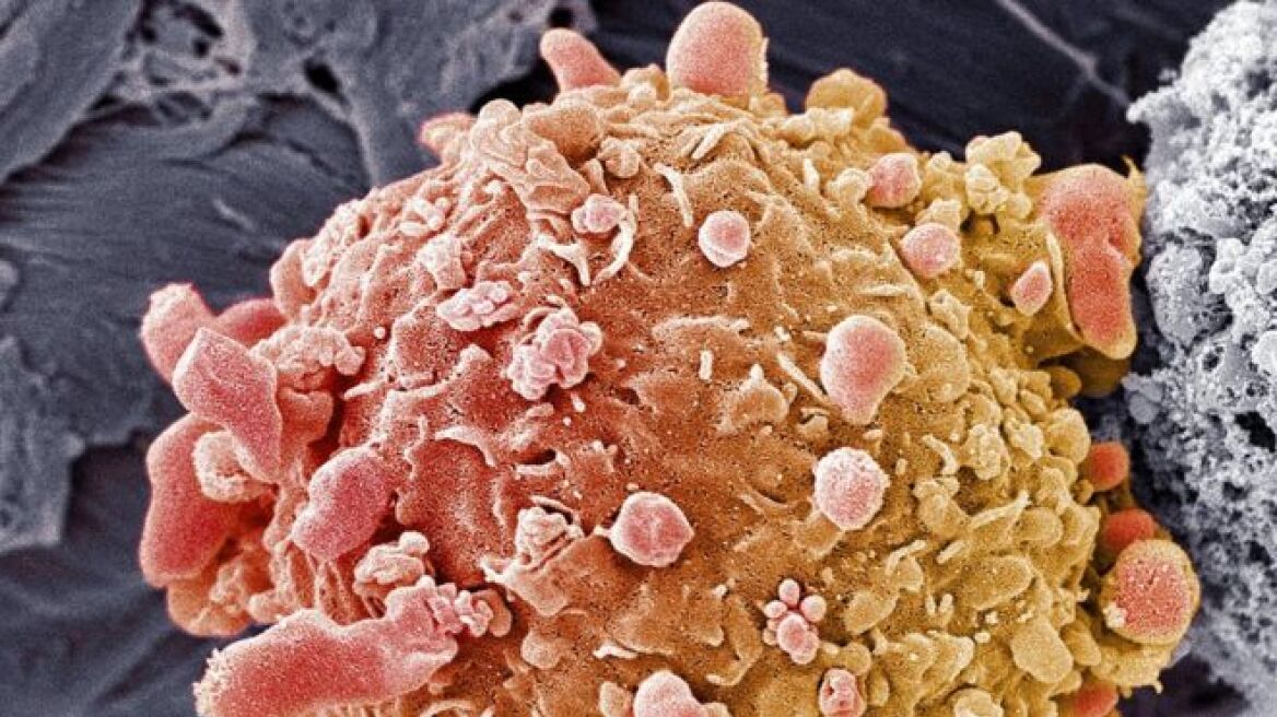 Έρευνα: Συνδυαστική θεραπεία δίνει ελπίδα σε ασθενείς με μελάνωμα