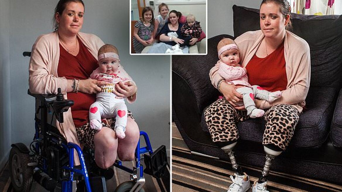 Shocking: Mother wakes up from C-section with no legs (pics)