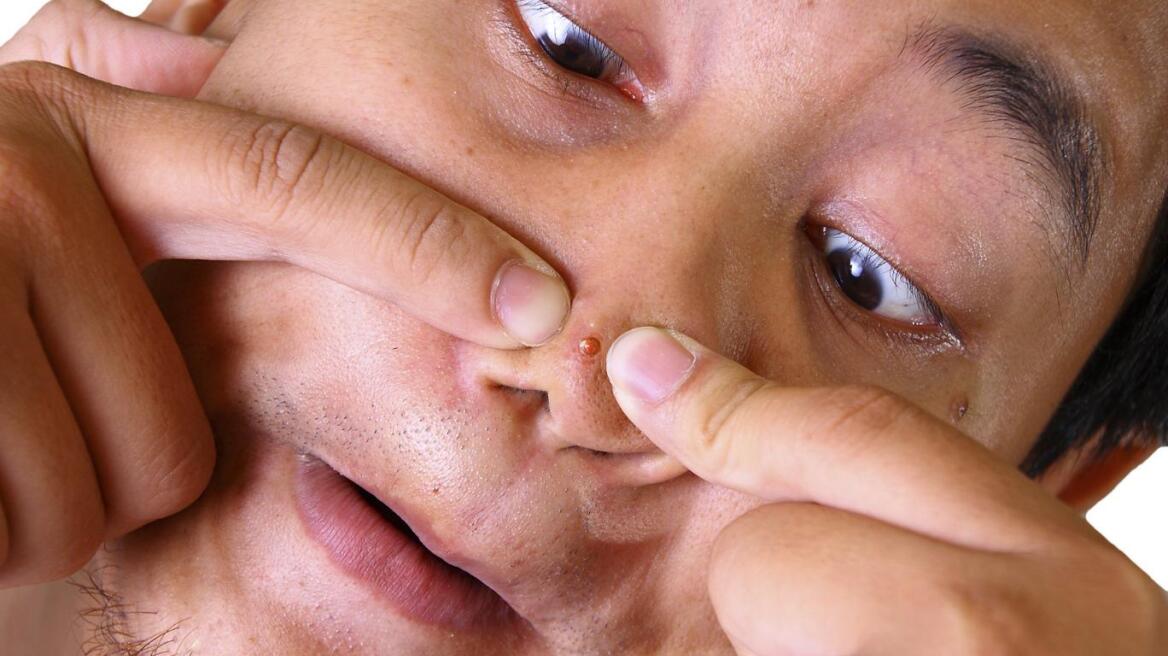 Μη σπας ποτέ σπυράκια σε αυτήν την περιοχή του προσώπου - Μπορεί να χάσεις τη ζωή σου!