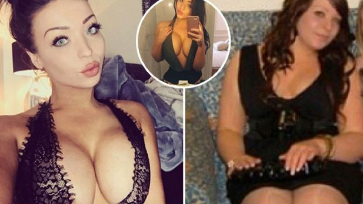 Θύμα bullying ξόδεψε 27.000 λίρες σε πλαστικές επεμβάσεις