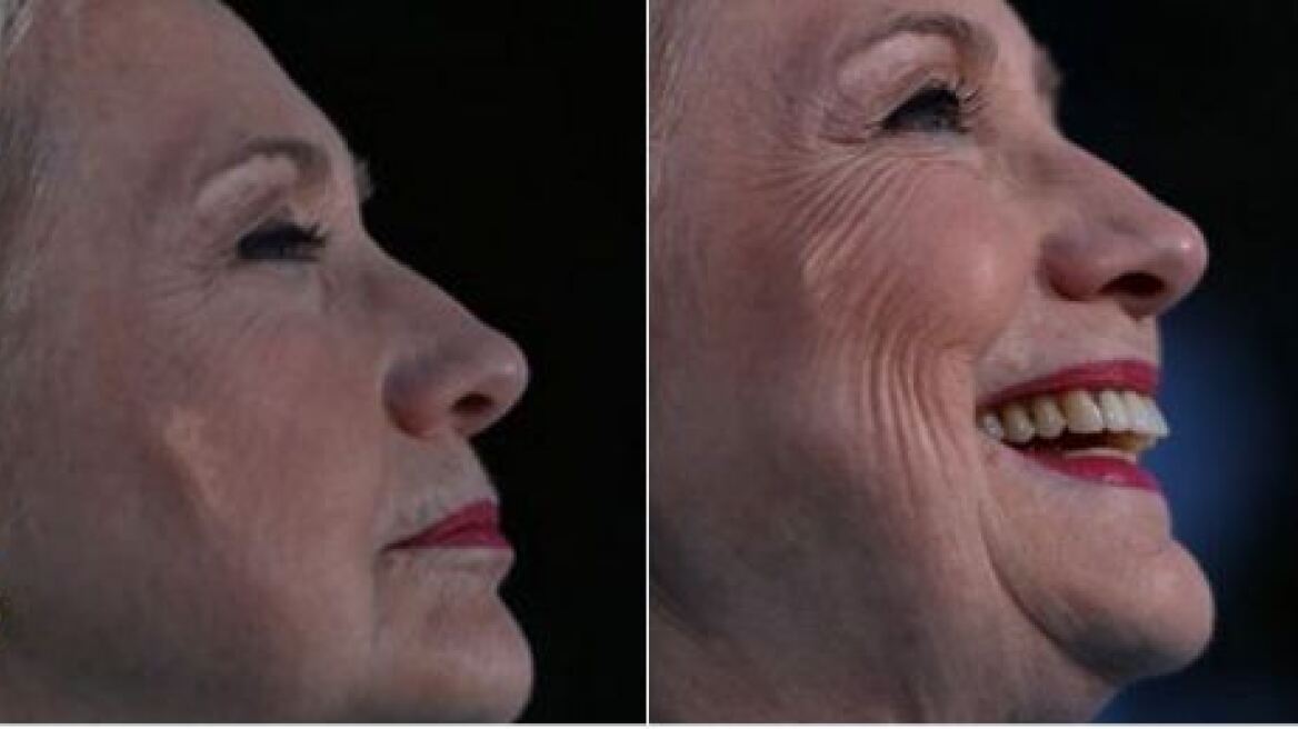 Φωτογραφία σοκ: Τι έχει το μάγουλο της Χίλαρι; 