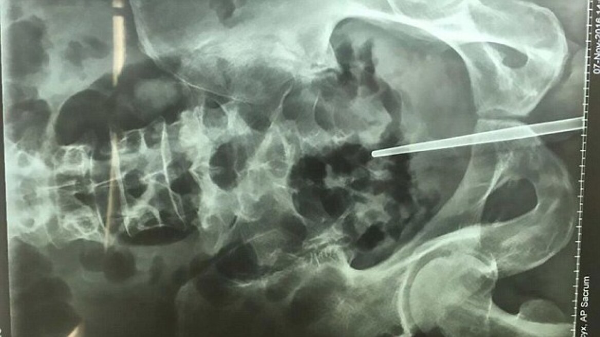 Κινέζος έμπηξε ένα chopstick στο πέος του επειδή... φοβόταν να πάει στον γιατρό