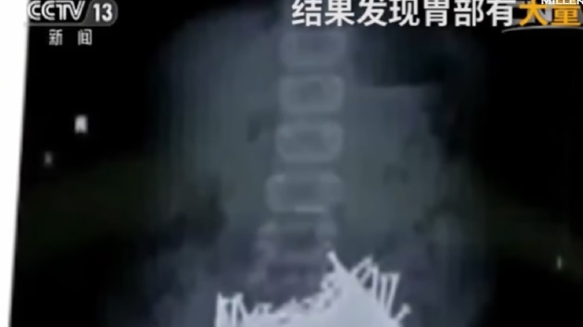 Σοκ: Μαθητής θύμα bullying κατάπιε 700 γραμμάρια καρφιά για να αυτοκτονήσει