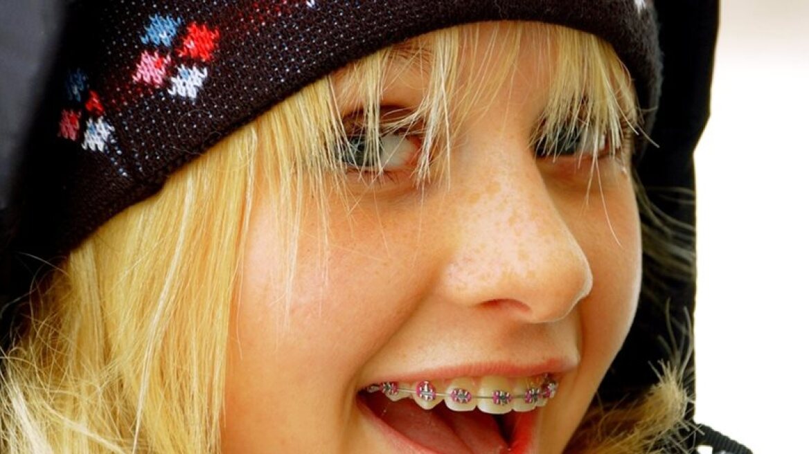 «Σιδεράκια» και γιορτές: Τι μπορείτε να τρώτε, τι πρέπει να προσέχετε  