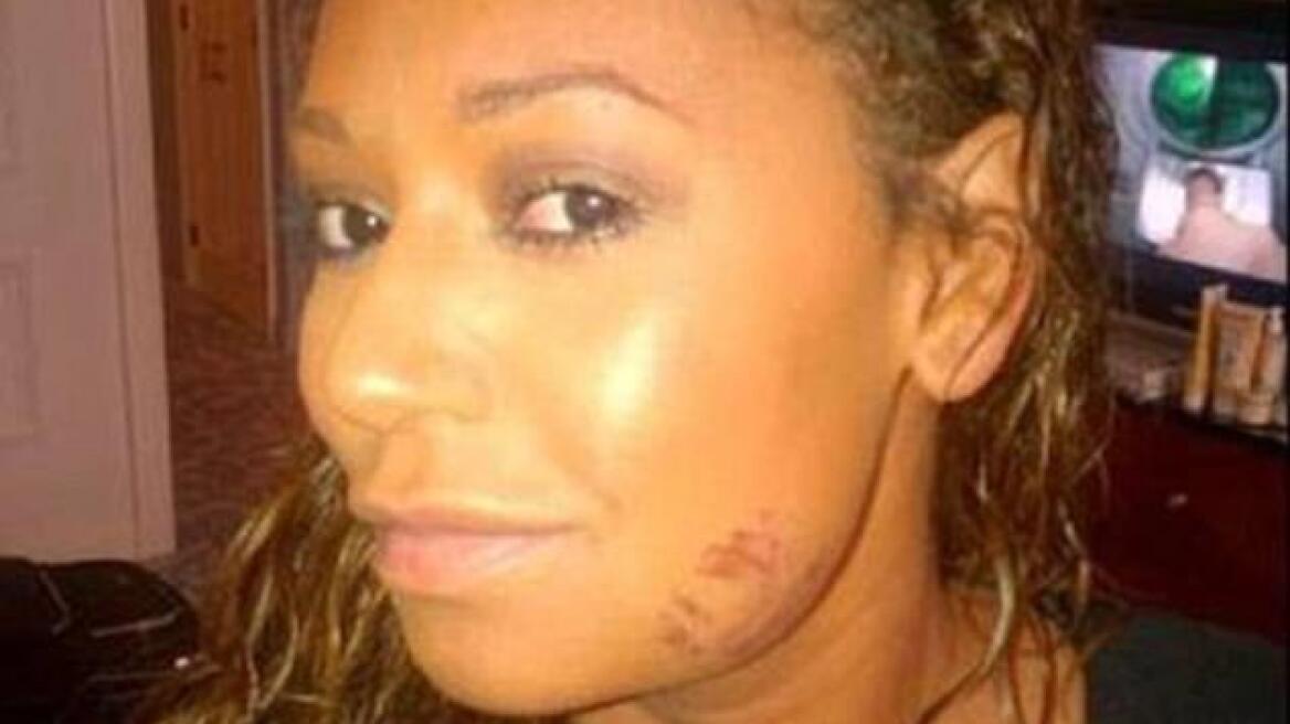 Πρώην «Spice Girl» καταγγέλλει: Ο σύζυγός μου με κακοποιούσε, με ανάγκαζε σε τρίο και άφησε έγκυο τη νταντά