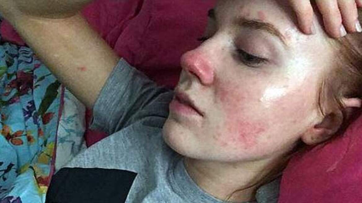 Το άγχος προκαλεί ψωρίαση;