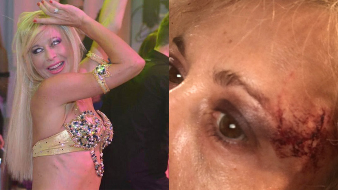 Η χορεύτρια Αλεξάνδρα Φωτεινού μιλάει για τον ξυλοδαρμό της- «Με βούτηξε και άρχισε να με γρονθοκοπεί»