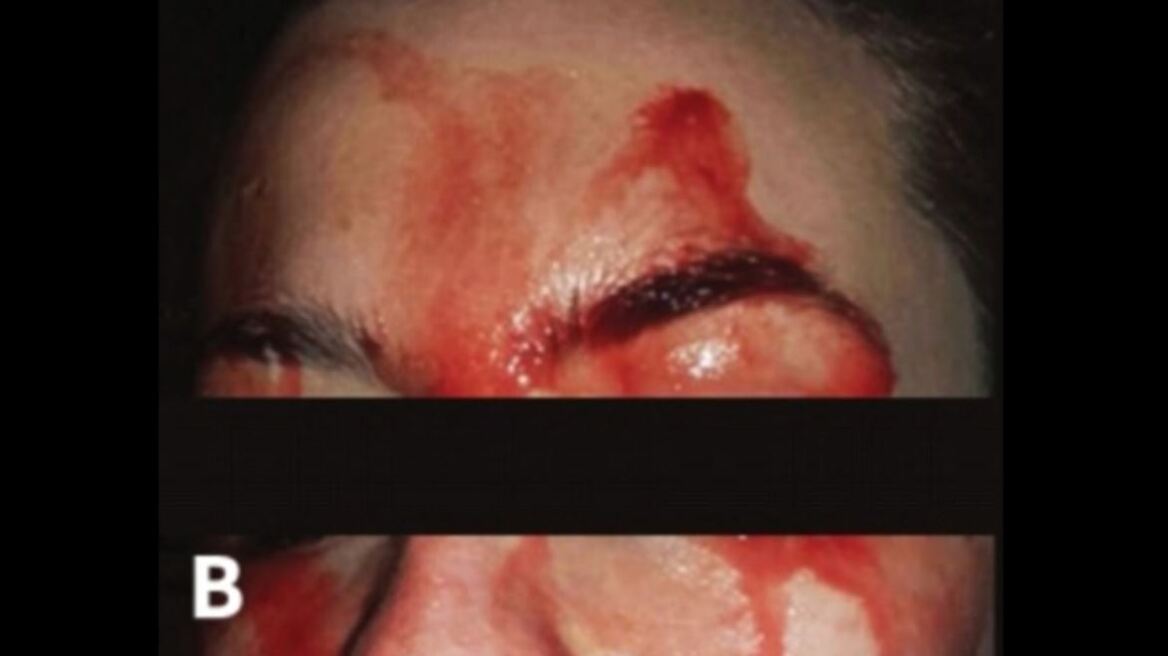 Μυστήριο με Ιταλίδα που ματώνει χωρίς λόγο από το πρόσωπο και τα χέρια 