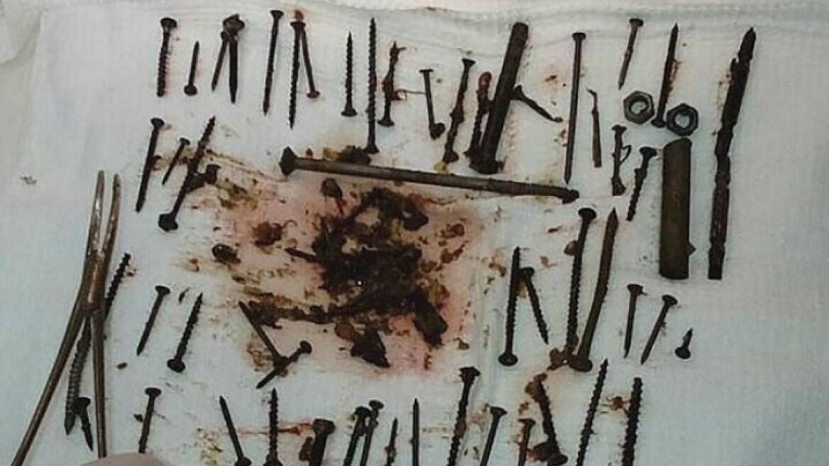 Μια γυναίκα κατάπιε καρφιά και βίδες επειδή είχε χαμηλό σίδηρο! (pics)