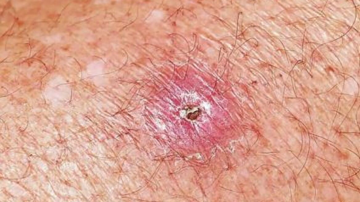 Αυστραλία: Έντονη ανησυχία για την εξάπλωση ιού που προκαλεί σαρκοφάγο έλκος