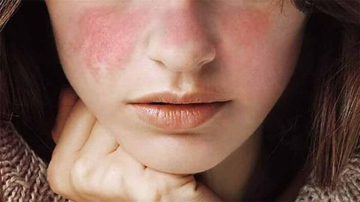 Συστηματικός Ερυθηματώδης Λύκος: Ένας... «λύκος» που εξουθενώνει τους ασθενείς